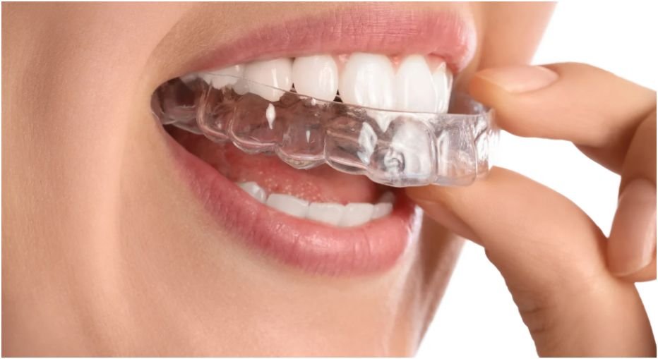 What to Know Before Getting an Invisible Aligner in Selkirk